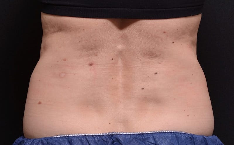 CoolSculpting Before & After Gallery - Patient 403946 - Image 1