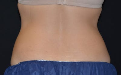 CoolSculpting Before & After Gallery - Patient 351223 - Image 2