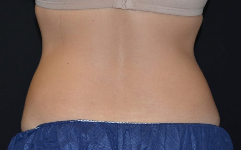 CoolSculpting Before & After Gallery - Patient 351223 - Image 2