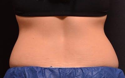 CoolSculpting Before & After Gallery - Patient 351223 - Image 1