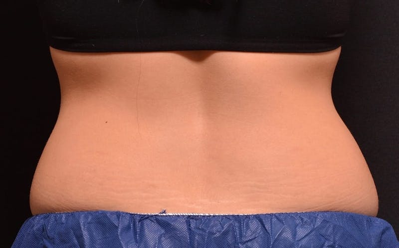 CoolSculpting Before & After Gallery - Patient 351223 - Image 1
