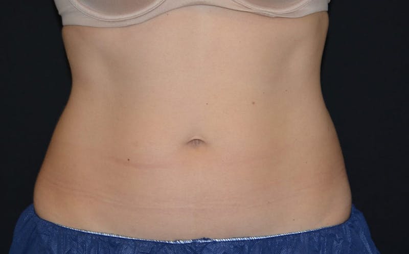 CoolSculpting Before & After Gallery - Patient 351223 - Image 4