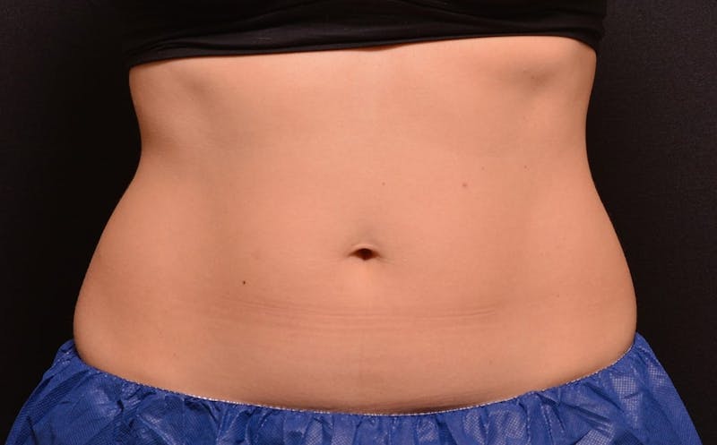 CoolSculpting Before & After Gallery - Patient 351223 - Image 3