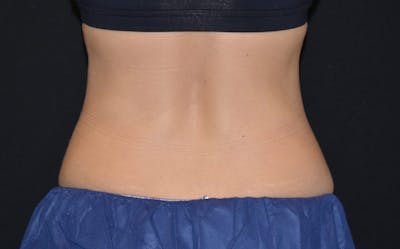 CoolSculpting Before & After Gallery - Patient 197881 - Image 2