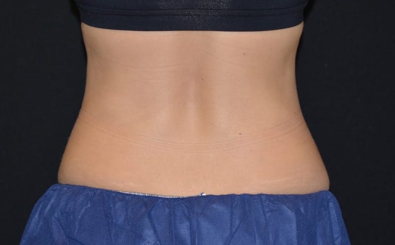 CoolSculpting Before & After Gallery - Patient 197881 - Image 2