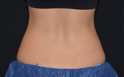 CoolSculpting Before & After Gallery - Patient 197881 - Image 1