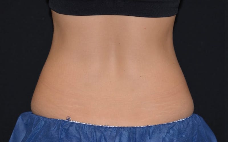 CoolSculpting Before & After Gallery - Patient 197881 - Image 1