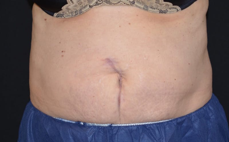 CoolSculpting Before & After Gallery - Patient 210128 - Image 2