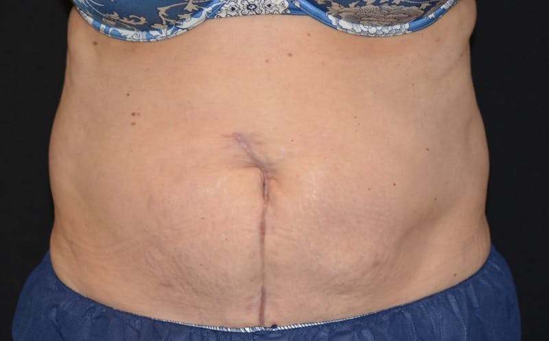 CoolSculpting Before & After Gallery - Patient 210128 - Image 1