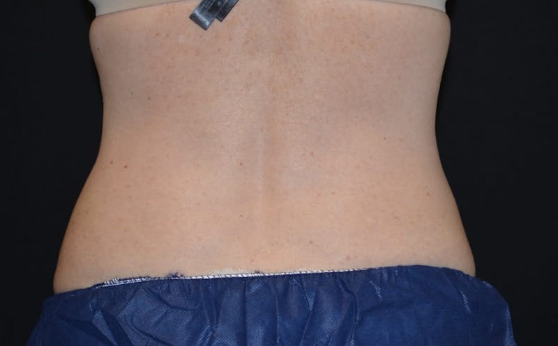 CoolSculpting Before & After Gallery - Patient 929418 - Image 2