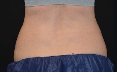 CoolSculpting Before & After Gallery - Patient 929418 - Image 1