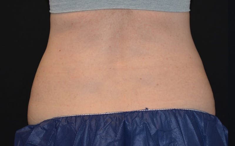 CoolSculpting Before & After Gallery - Patient 929418 - Image 1