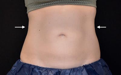 CoolSculpting Before & After Gallery - Patient 275099 - Image 2