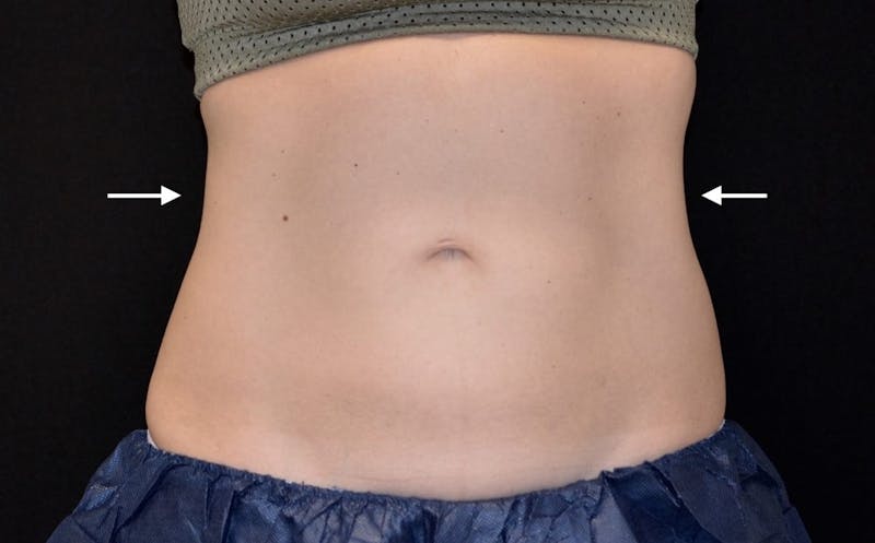 CoolSculpting Before & After Gallery - Patient 275099 - Image 2