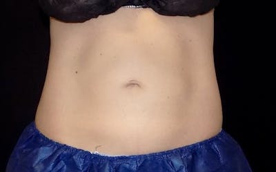 CoolSculpting Before & After Gallery - Patient 275099 - Image 1