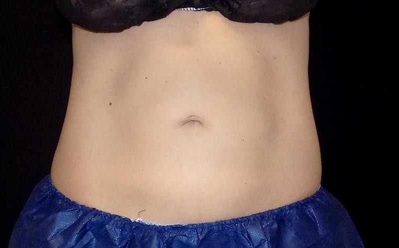 CoolSculpting Before & After Gallery - Patient 275099 - Image 1