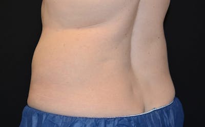 CoolSculpting Before & After Gallery - Patient 265188 - Image 2