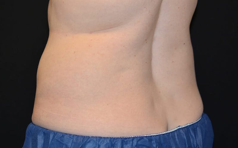 CoolSculpting Before & After Gallery - Patient 265188 - Image 2