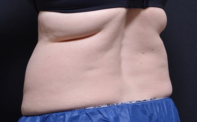CoolSculpting Before & After Gallery - Patient 265188 - Image 1