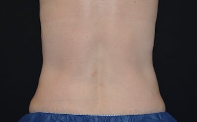 CoolSculpting Before & After Gallery - Patient 388228 - Image 2