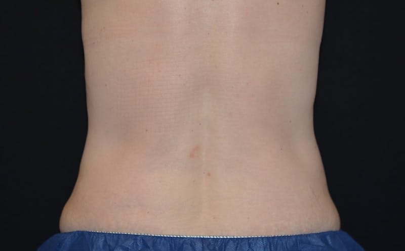 CoolSculpting Before & After Gallery - Patient 388228 - Image 2