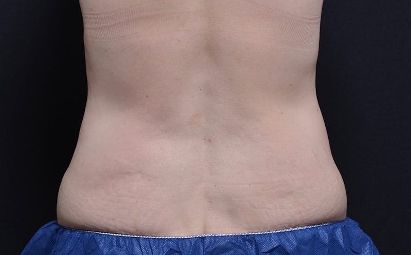 CoolSculpting Before & After Gallery - Patient 388228 - Image 1