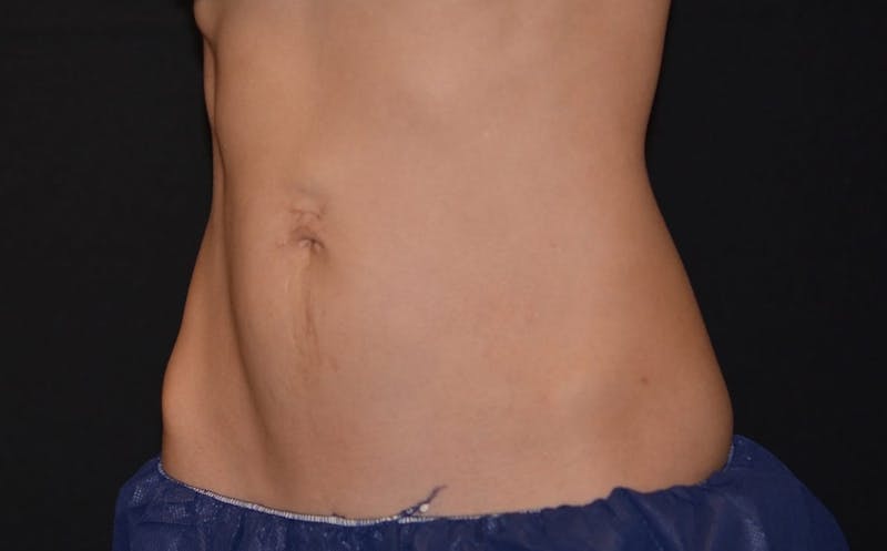 CoolSculpting Before & After Gallery - Patient 221375 - Image 2