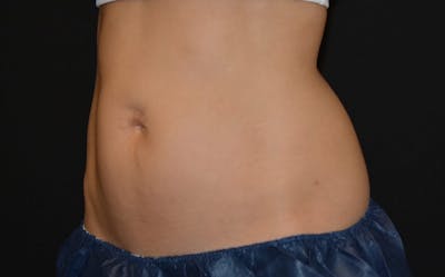 CoolSculpting Before & After Gallery - Patient 221375 - Image 1