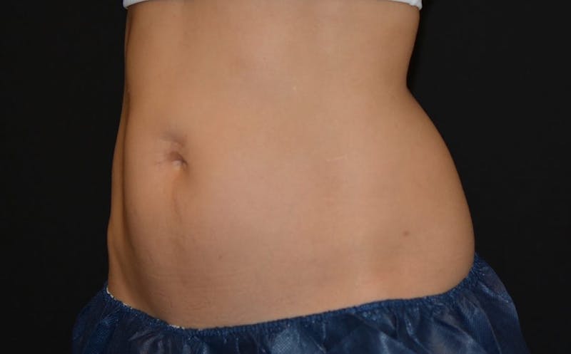 CoolSculpting Before & After Gallery - Patient 221375 - Image 1