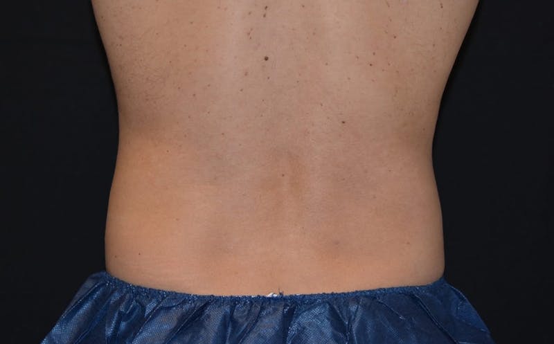 CoolSculpting Before & After Gallery - Patient 330991 - Image 2
