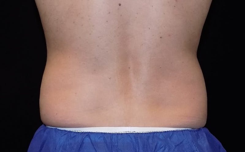 CoolSculpting Before & After Gallery - Patient 330991 - Image 1
