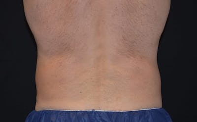 CoolSculpting Before & After Gallery - Patient 332959 - Image 2
