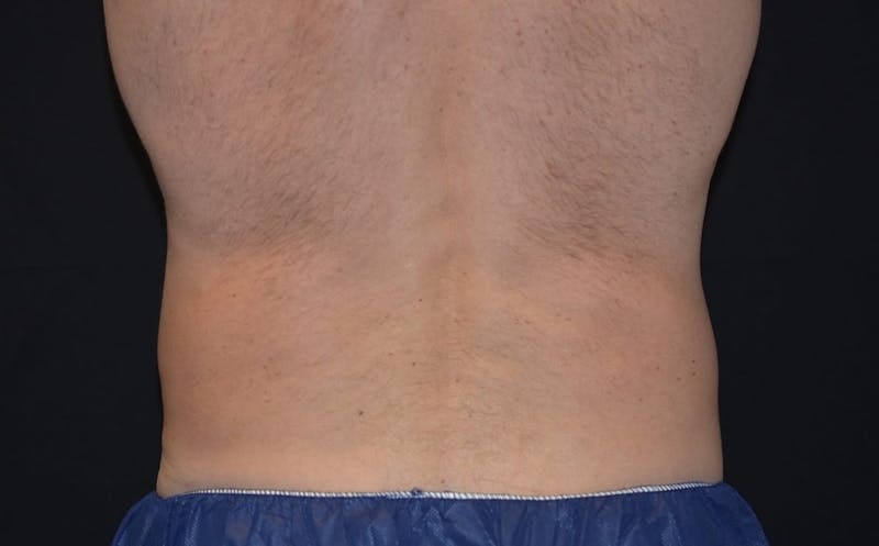 CoolSculpting Before & After Gallery - Patient 332959 - Image 2
