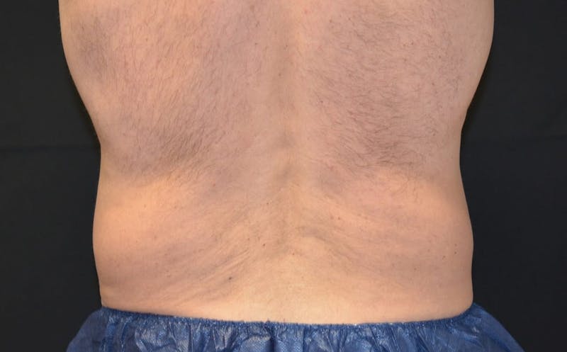 CoolSculpting Before & After Gallery - Patient 332959 - Image 1