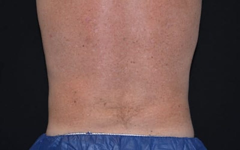 CoolSculpting Before & After Gallery - Patient 332757 - Image 3