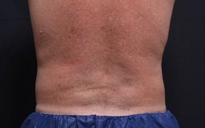 CoolSculpting Before & After Gallery - Patient 332757 - Image 2