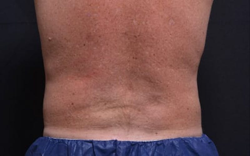 CoolSculpting Before & After Gallery - Patient 332757 - Image 2