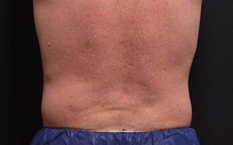CoolSculpting Before & After Gallery - Patient 332757 - Image 1