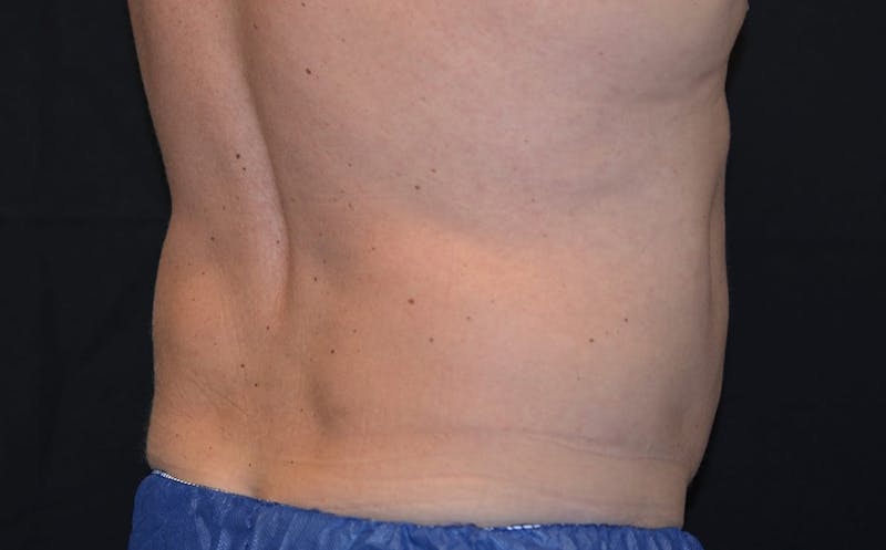 CoolSculpting Before & After Gallery - Patient 128645 - Image 2