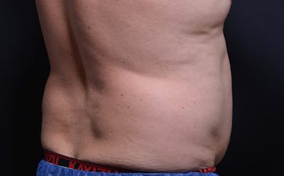 CoolSculpting Before & After Gallery - Patient 128645 - Image 1