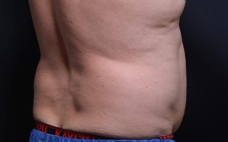 CoolSculpting Before & After Gallery - Patient 128645 - Image 1