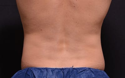 CoolSculpting Before & After Gallery - Patient 863396 - Image 2