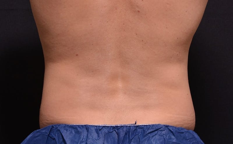 CoolSculpting Before & After Gallery - Patient 863396 - Image 2