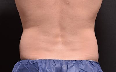 CoolSculpting Before & After Gallery - Patient 863396 - Image 1