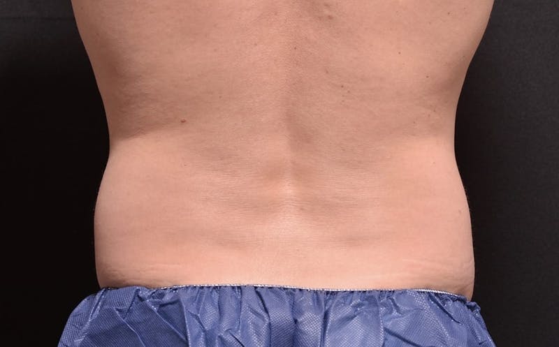 CoolSculpting Before & After Gallery - Patient 863396 - Image 1