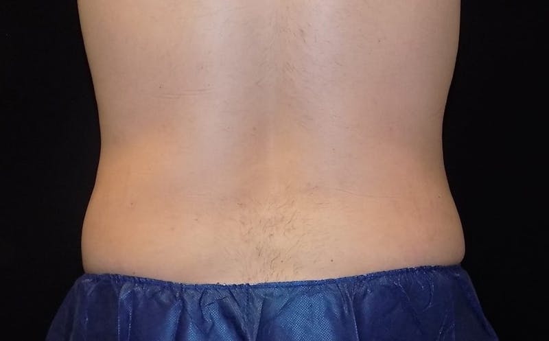 CoolSculpting Before & After Gallery - Patient 106681 - Image 2