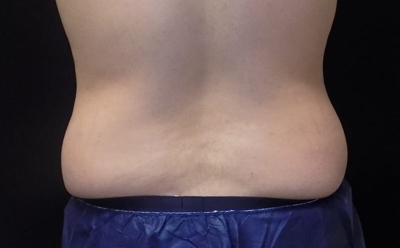 CoolSculpting Before & After Gallery - Patient 106681 - Image 1