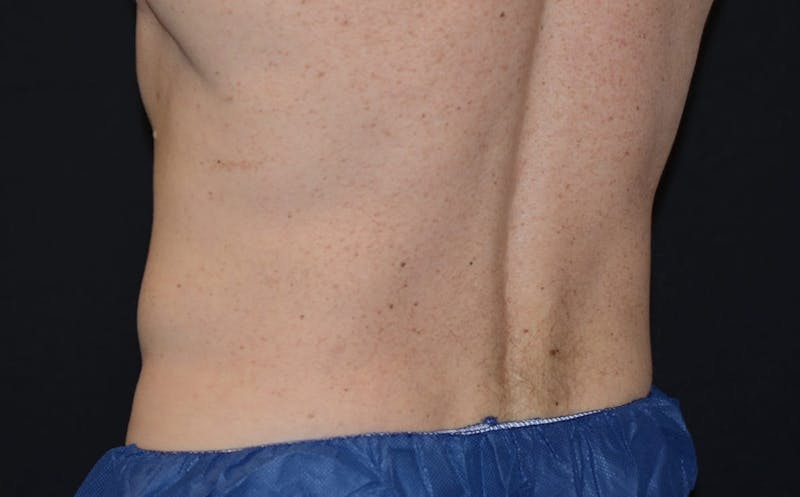 CoolSculpting Before & After Gallery - Patient 322694 - Image 2