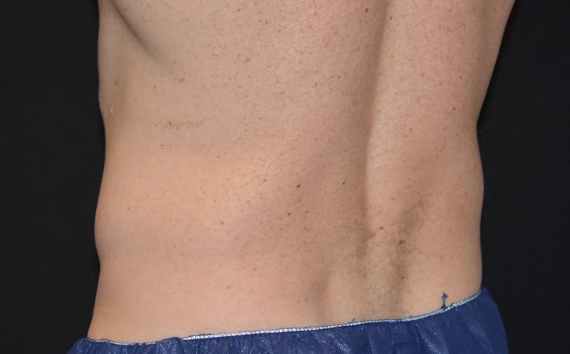 CoolSculpting Before & After Gallery - Patient 322694 - Image 1