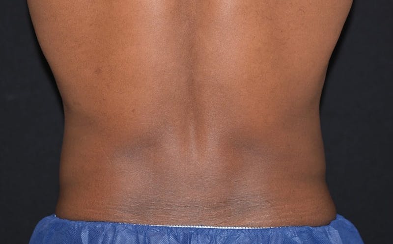 CoolSculpting Before & After Gallery - Patient 154148 - Image 2